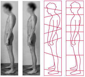 Rolfing before and after